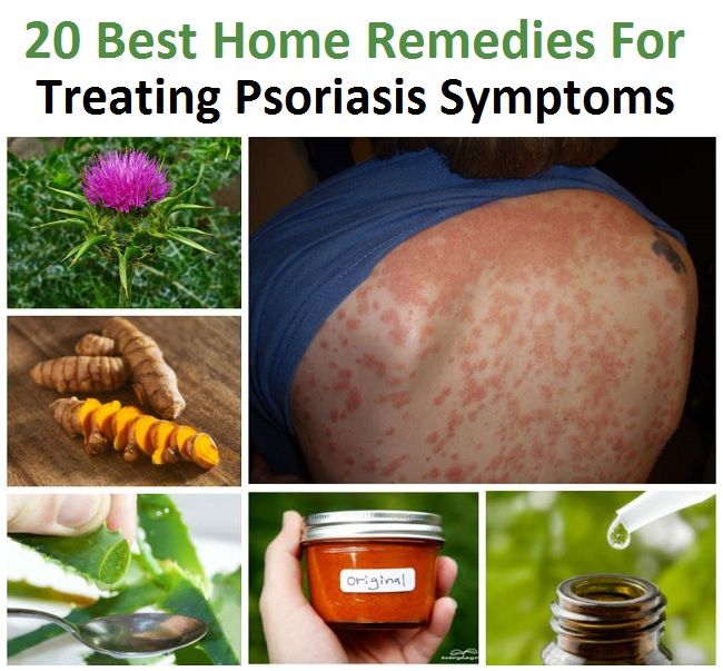 20 mejores remedios caseros para el tratamiento de los síntomas de la psoriasis