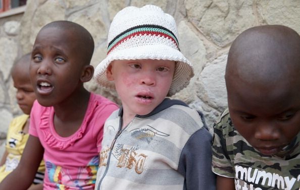 A los niños con albinismo en Lesotho. En algunas partes de África la gente con albinismo son cazados y asesinados o mutilados.