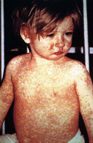 Un niño que muestra la firma exantema del sarampión.