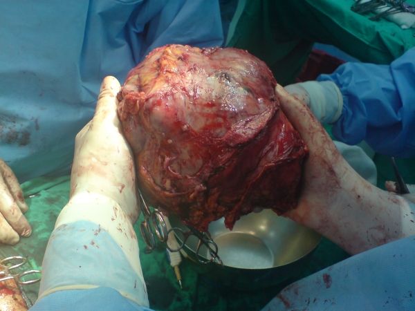 Gran tumor en el hígado