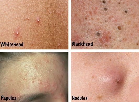 El acné y Tipos de acné