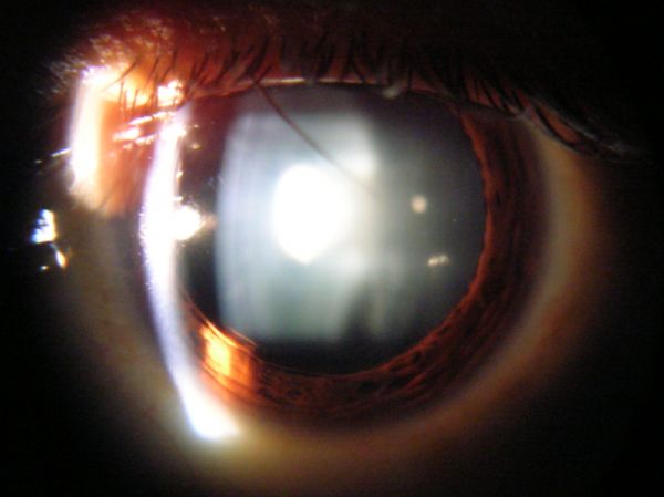 Vista con lámpara de hendidura de la catarata en el ojo humano