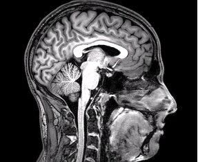 Una resonancia magnética del cerebro.
