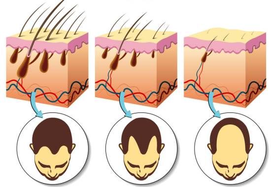 Remedios caseros para la Alopecia Tratamiento Naturalmente