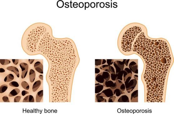 Remedios caseros para el tratamiento de la osteoporosis Naturalmente