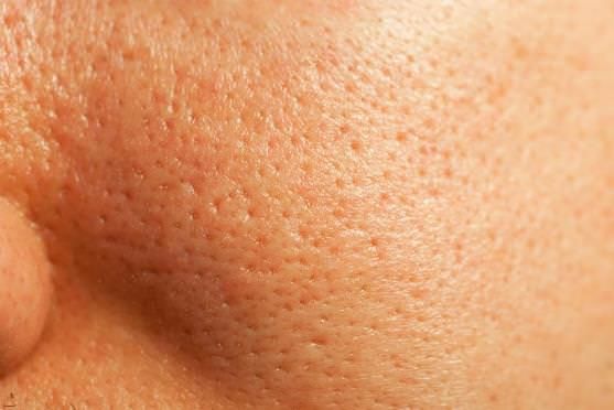 Remedios caseros para deshacerse de los poros tapados