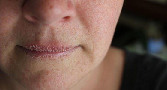 ¿Cómo deshacerse de los labios agrietados Rápido y Naturalmente