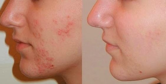 Cómo curar el acné rápido y de forma natural?
