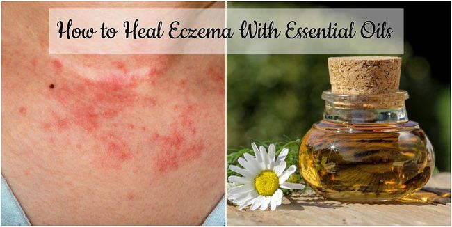 Cómo curar el eczema con aceites esenciales