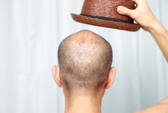 Cómo prevenir la pérdida de cabello en las mujeres y los hombres