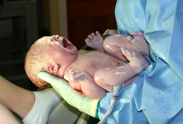 El parto por cesárea aumenta un bebé`s chance of surviving during a breech pregnancy.