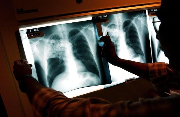 Chest s rayos de una persona con tuberculosis. Una mujer vino a los EE.UU. con la tuberculosis resistente a los medicamentos.