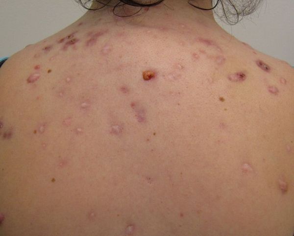 El acné quístico en la espalda.