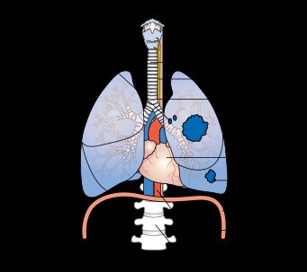 El cáncer de pulmón Diagrama 3A etapa de proyección.