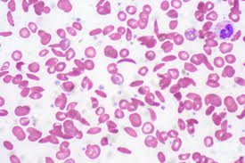 En la anemia de células falciformes, algunos glóbulos pueden pasar de la forma redonda normal en las células en forma de hoz rígidos.