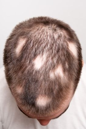 Los pacientes con alopecia areata creció el pelo hacia atrás después de la administración de drogas