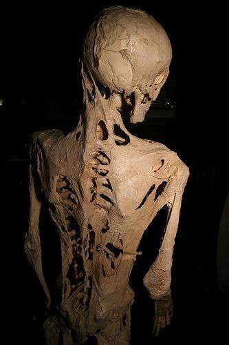 El esqueleto de una persona que sufría de fibrodisplasia osificante progresiva, una enfermedad poco frecuente que causa el tejido blando a su vez a los huesos.