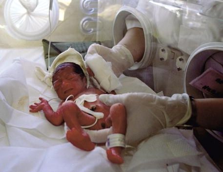 Los bebés prematuros corren un alto riesgo de desarrollar trastorno mental