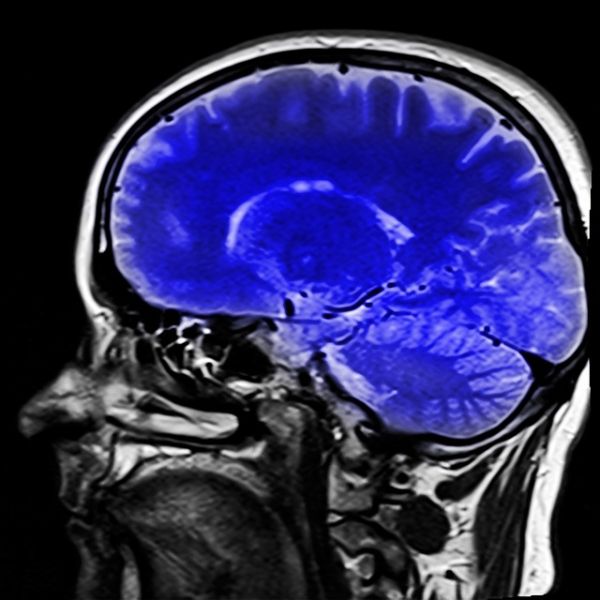 Imagen de resonancia magnética del cerebro