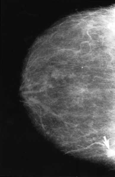 Mamografía con cáncer Obvio
