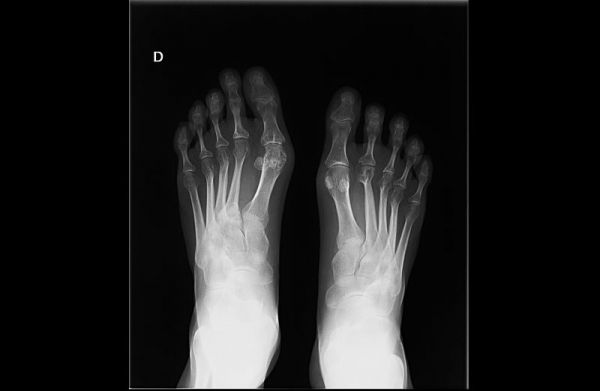 De rayos X de los pies de alguien con artritis reumatoide.