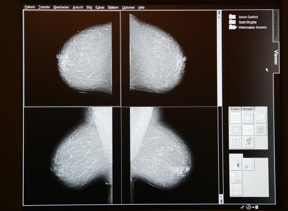 Una mujer que es diagnosticada con carcinoma ductal in situ, la etapa más baja de cáncer de mama, tiene un bajo riesgo de morir de cáncer de mama