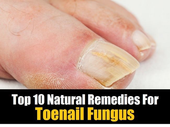 Top 10 de los remedios naturales para hongos en las uñas