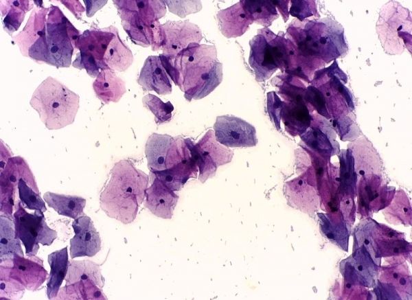 Una vista microscópica de células cervicales normales, tomada con una prueba de Papanicolaou.