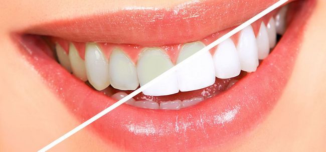 13 maneras simples de conseguir los dientes blancos Noche