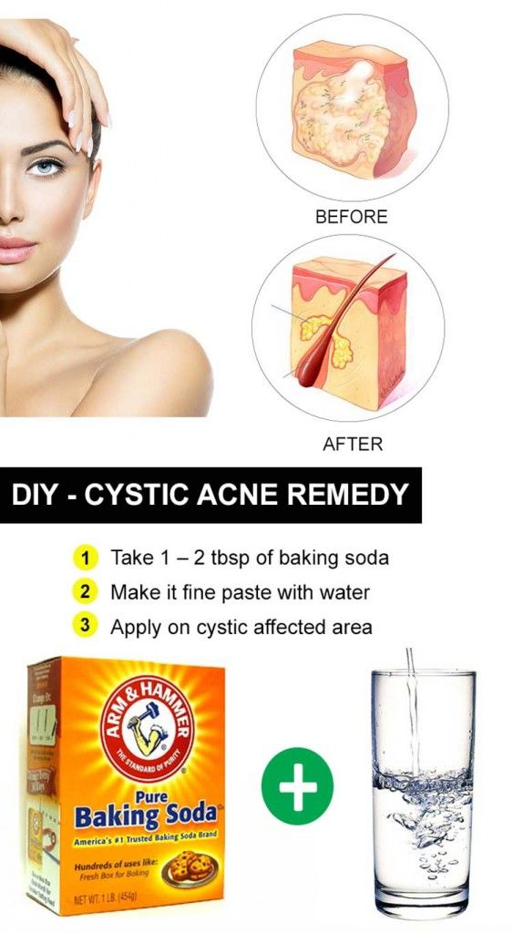 15 remedios caseros para el acné quístico Diy