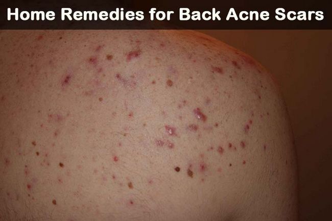 21 remedios caseros de bricolaje para las cicatrices de acné de espalda