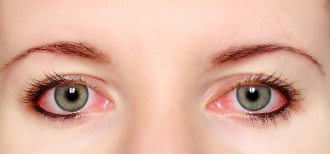 21 eficaz Remedios caseros para los ojos rojos