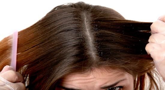 Mejores aceites para el cabello anticaspa disponibles en el mercado