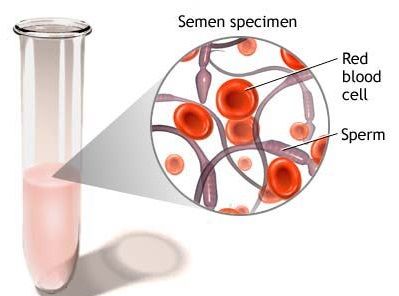 Sangre en el semen - causas, síntomas y tratamiento