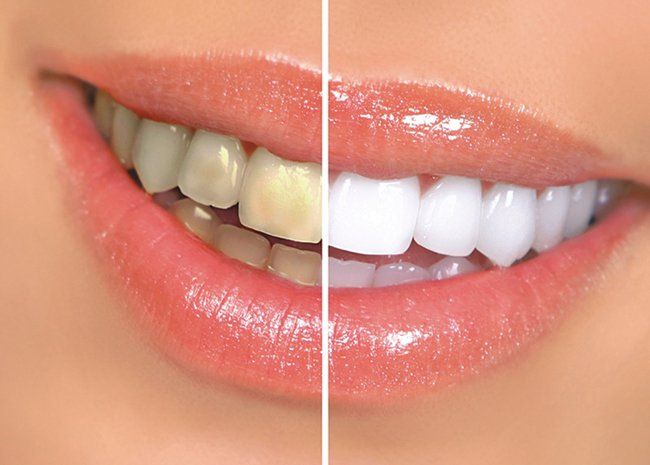 Causas de los dientes y de prevención puntas amarillas de dientes amarillos