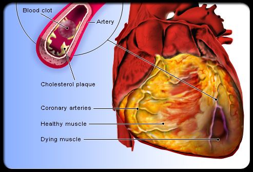 enfermedades cardíacas