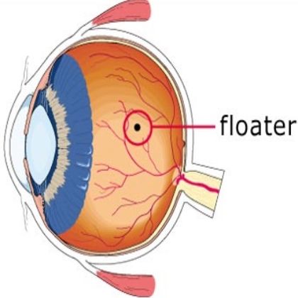 Flotadores del ojo? ¿Cómo reducir los flotadores del ojo
