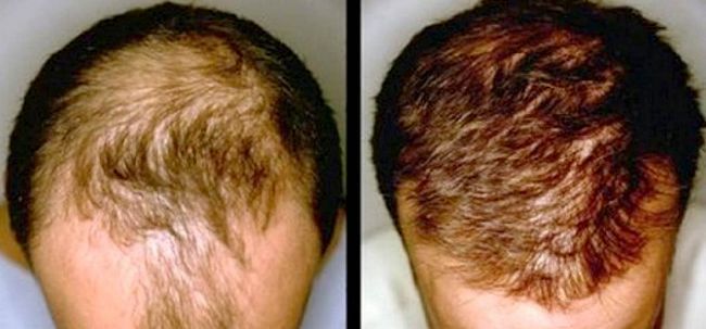 Crecimiento del pelo para la calvicie - Causas y Soluciones