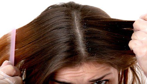 Los remedios herbarios para la caspa del cuero cabelludo que pica