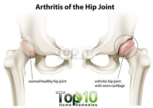 artritis de la articulación de la cadera