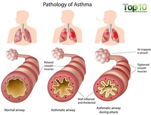 Anatomía del asma