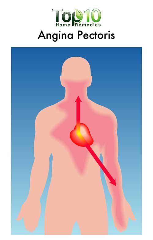 diagrama de la angina de pecho