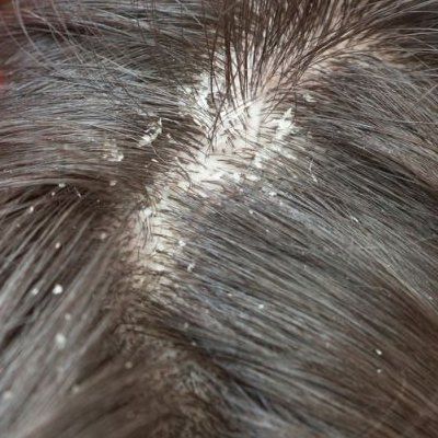 Remedios caseros para la caspa cuero cabelludo seco