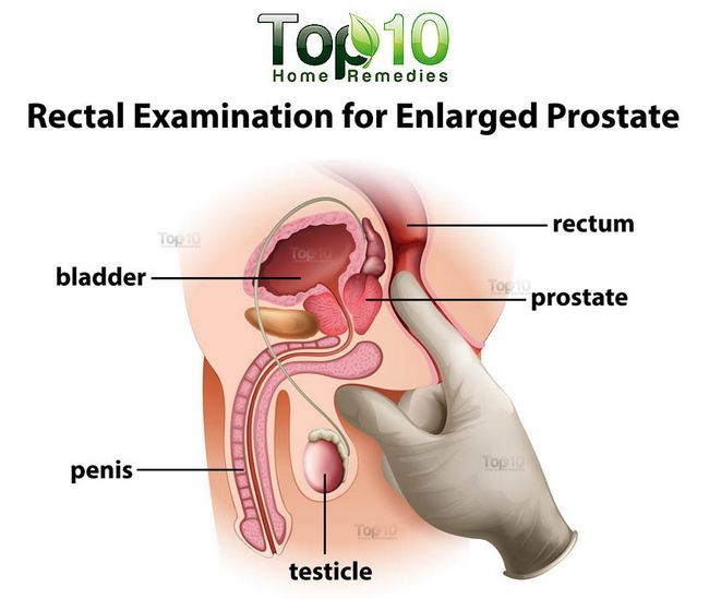 diagrama de agrandamiento de la próstata