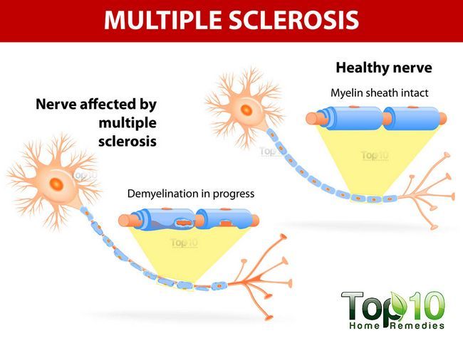 múltiple esclerosis ilustración