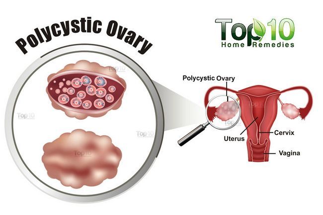 diagrama de ovario poliquístico