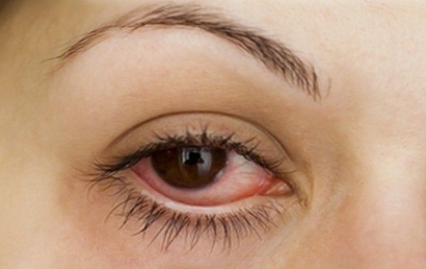 Los remedios caseros para tratar la picazón de ojos