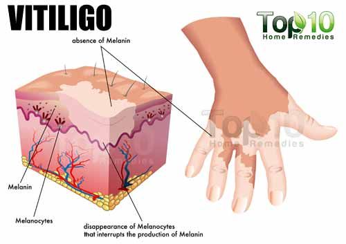 ilustración vitiligo