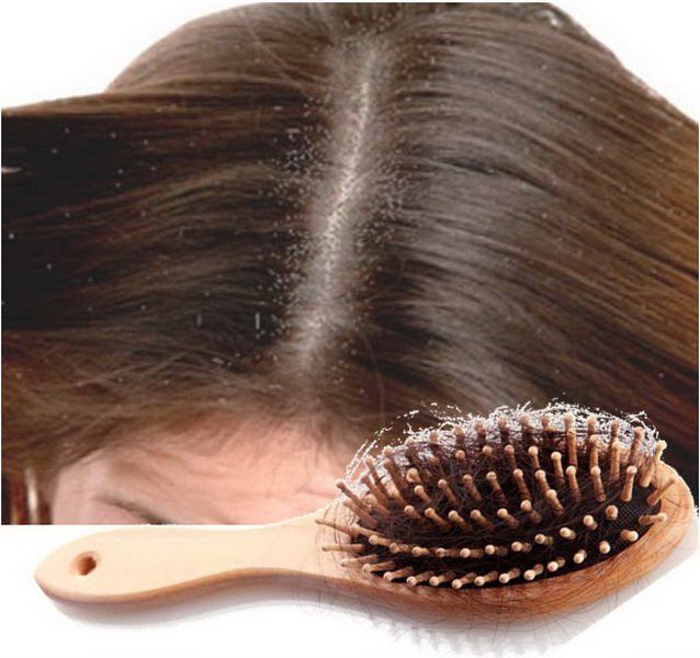 Cómo detener la caída del cabello debido a la caspa