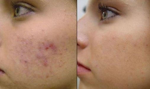 Cómo tratar las formas más graves de acné?